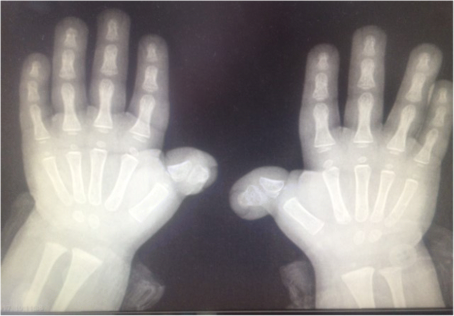 Two adults with Rubinstein–Taybi syndrome with mild mental retardation,  glaucoma, normal growth and skull circumference, and camptodactyly of third  fingers - Wieczorek - 2009 - American Journal of Medical Genetics Part A 