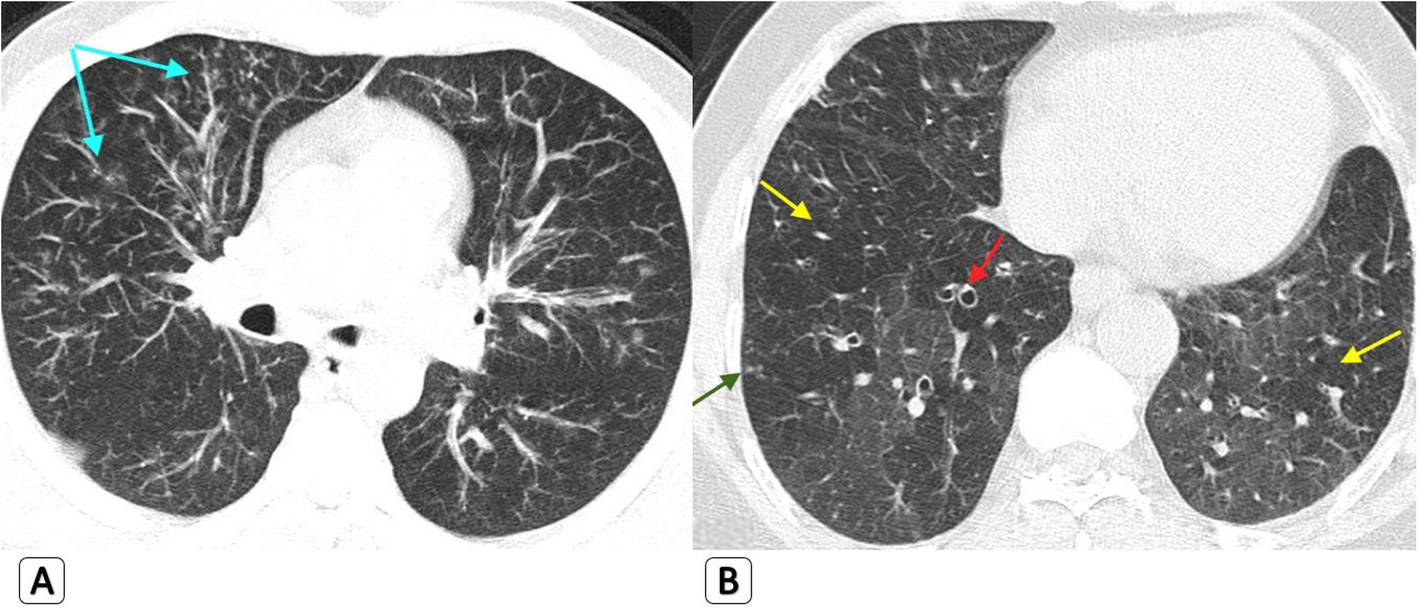Bronchiectasis: Current Clinical and Imaging Concepts