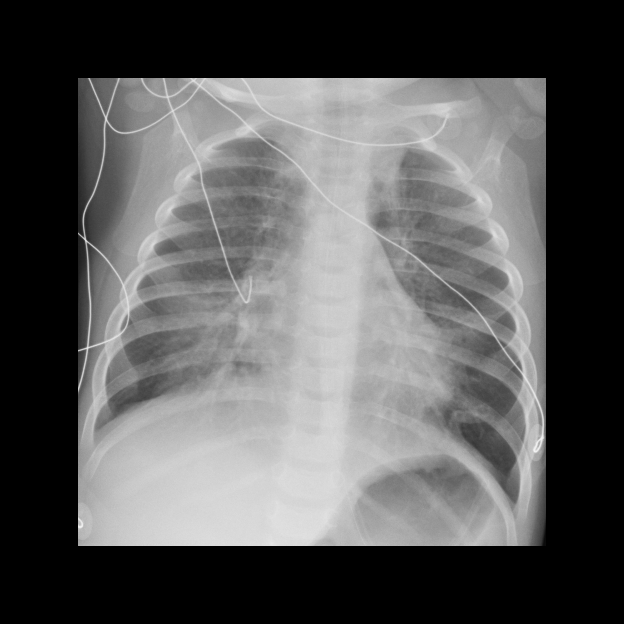 Scimitar syndrome | Radiology Case | Radiopaedia.org