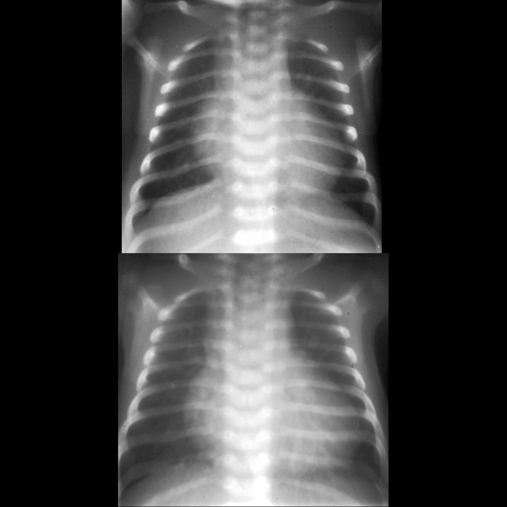 Truncus Arteriosus X Ray