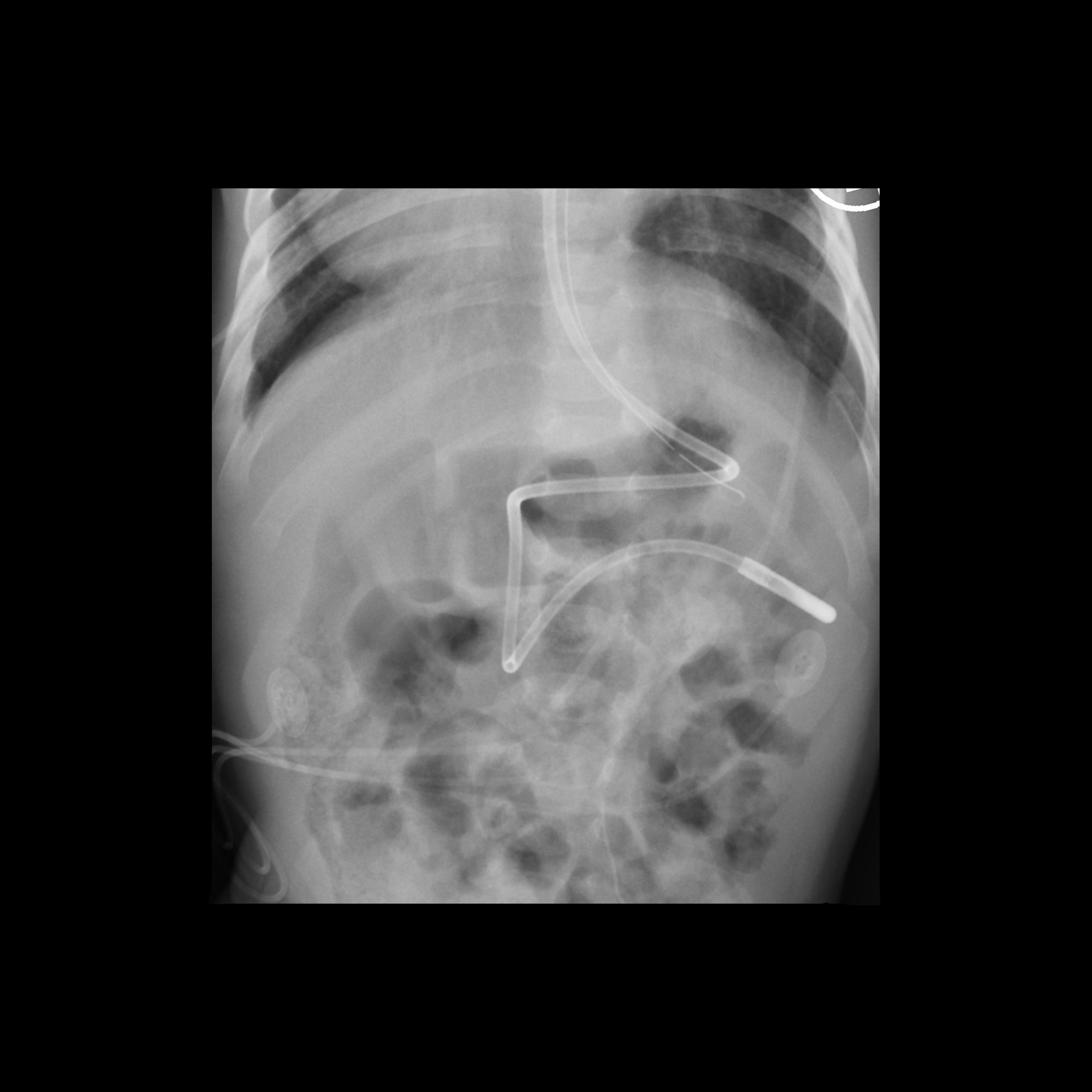 Ernährungssonde pacs