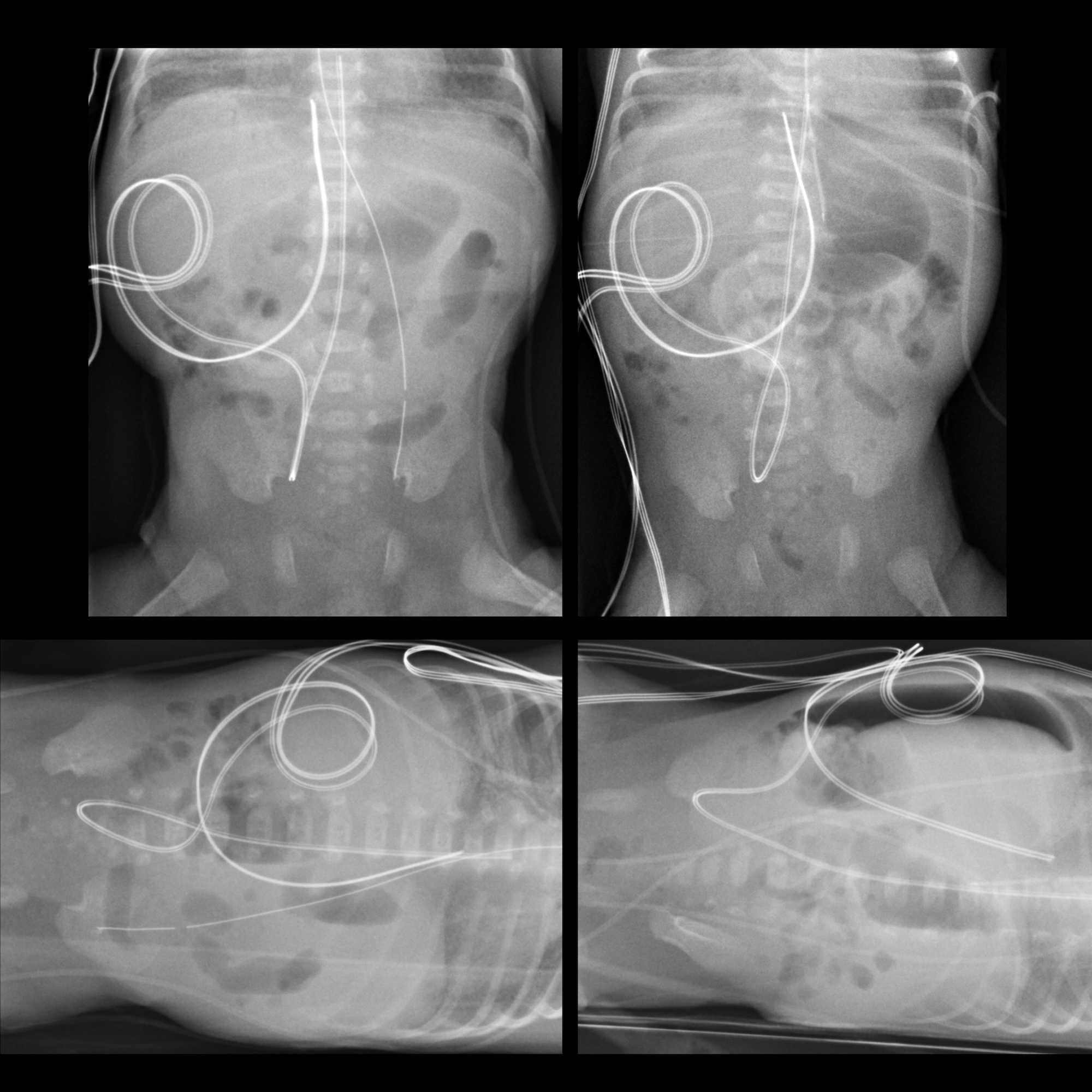 nasogastric-tube-pacs