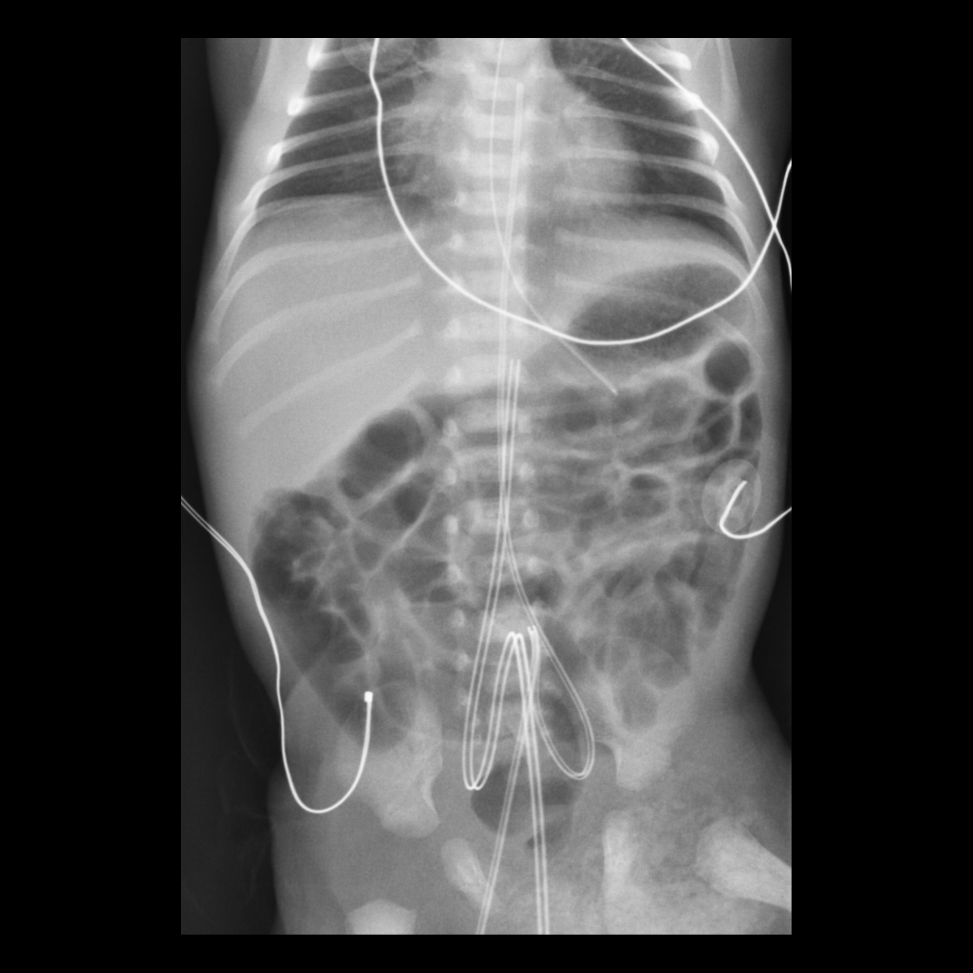 umbilical-arterial-catheters-pacs