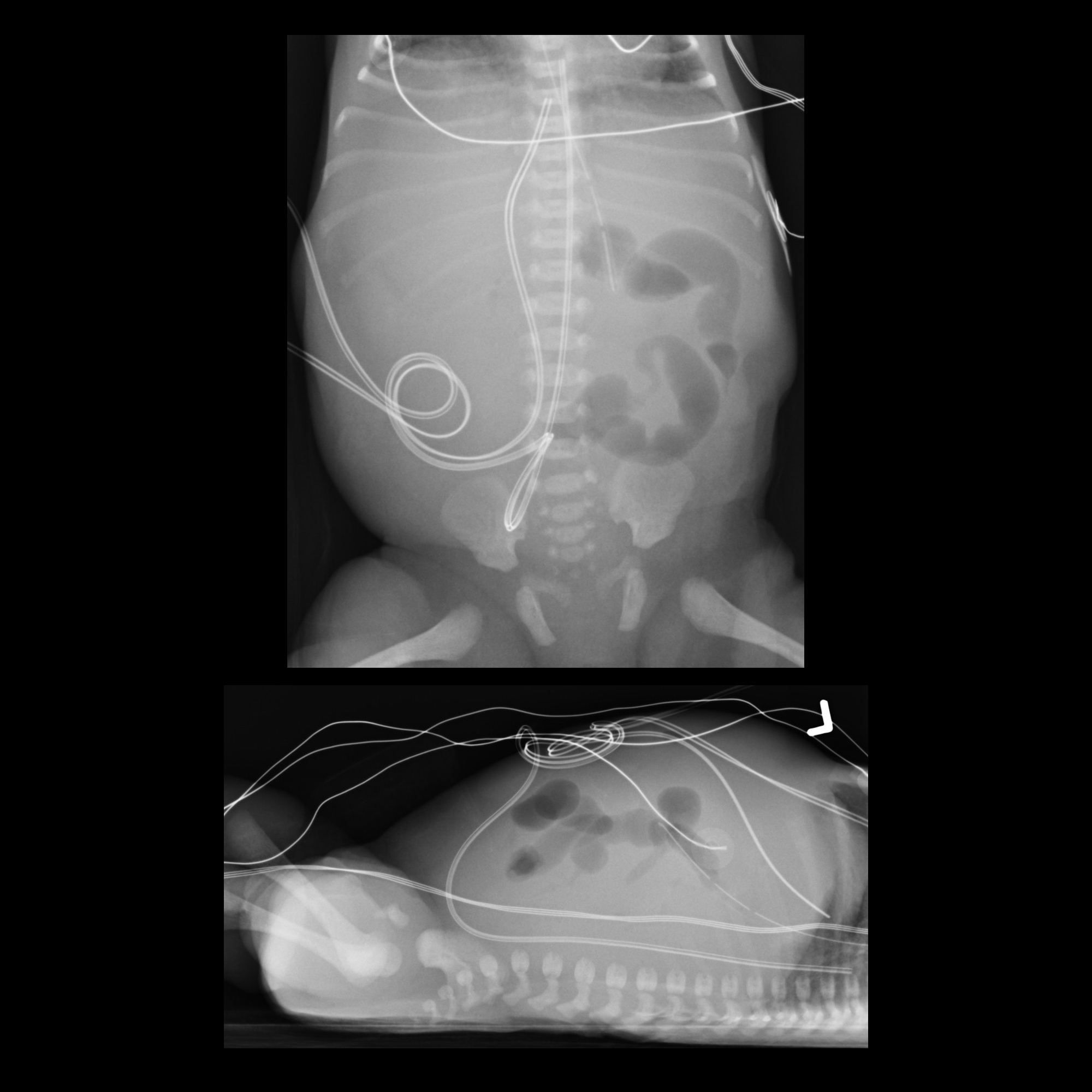 high-malposition-of-the-umbilical-arterial-catheter-pacs