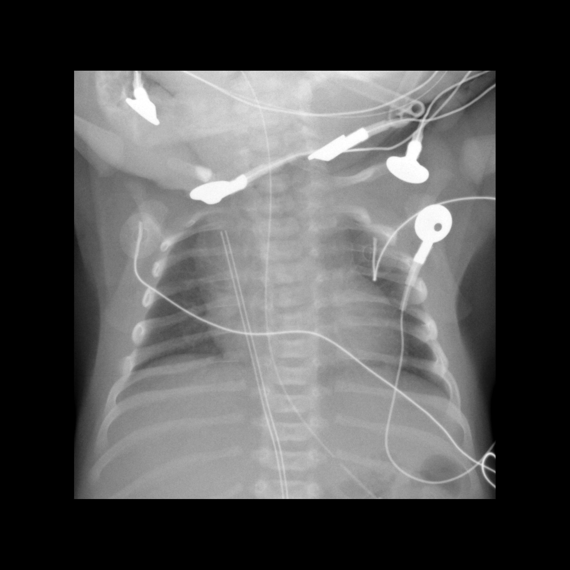 high malposition of the umbilical venous catheter | pacs