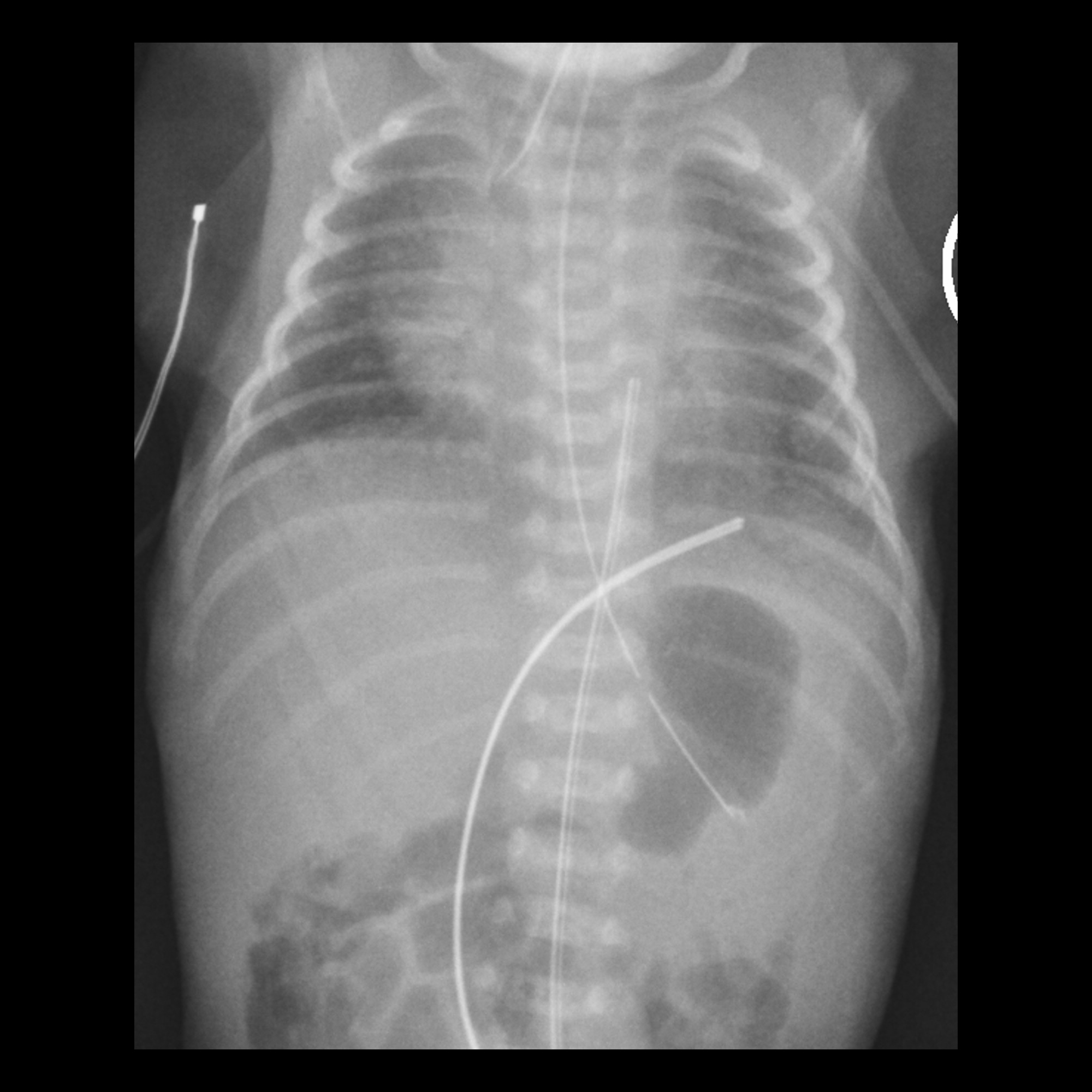 Low Malposition Of The Umbilical Venous Catheter Pacs