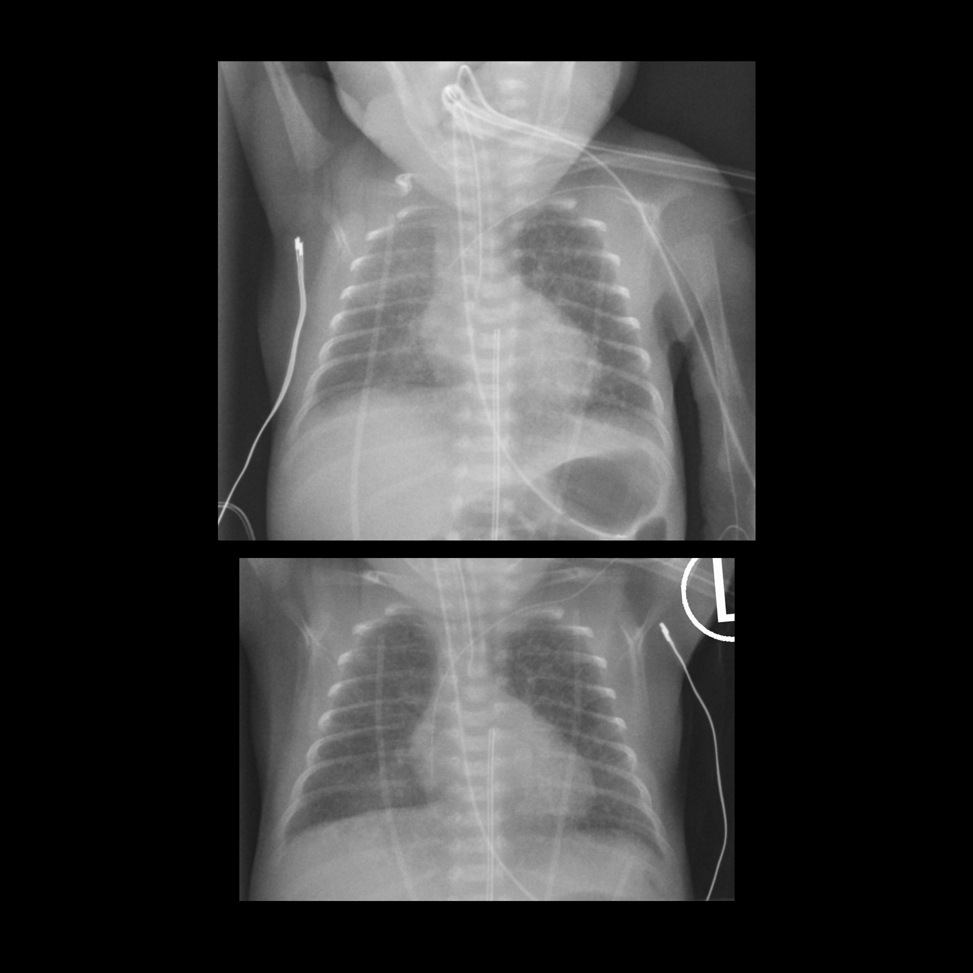 change-in-position-of-the-upper-extremity-picc-line-tip-due-to-change