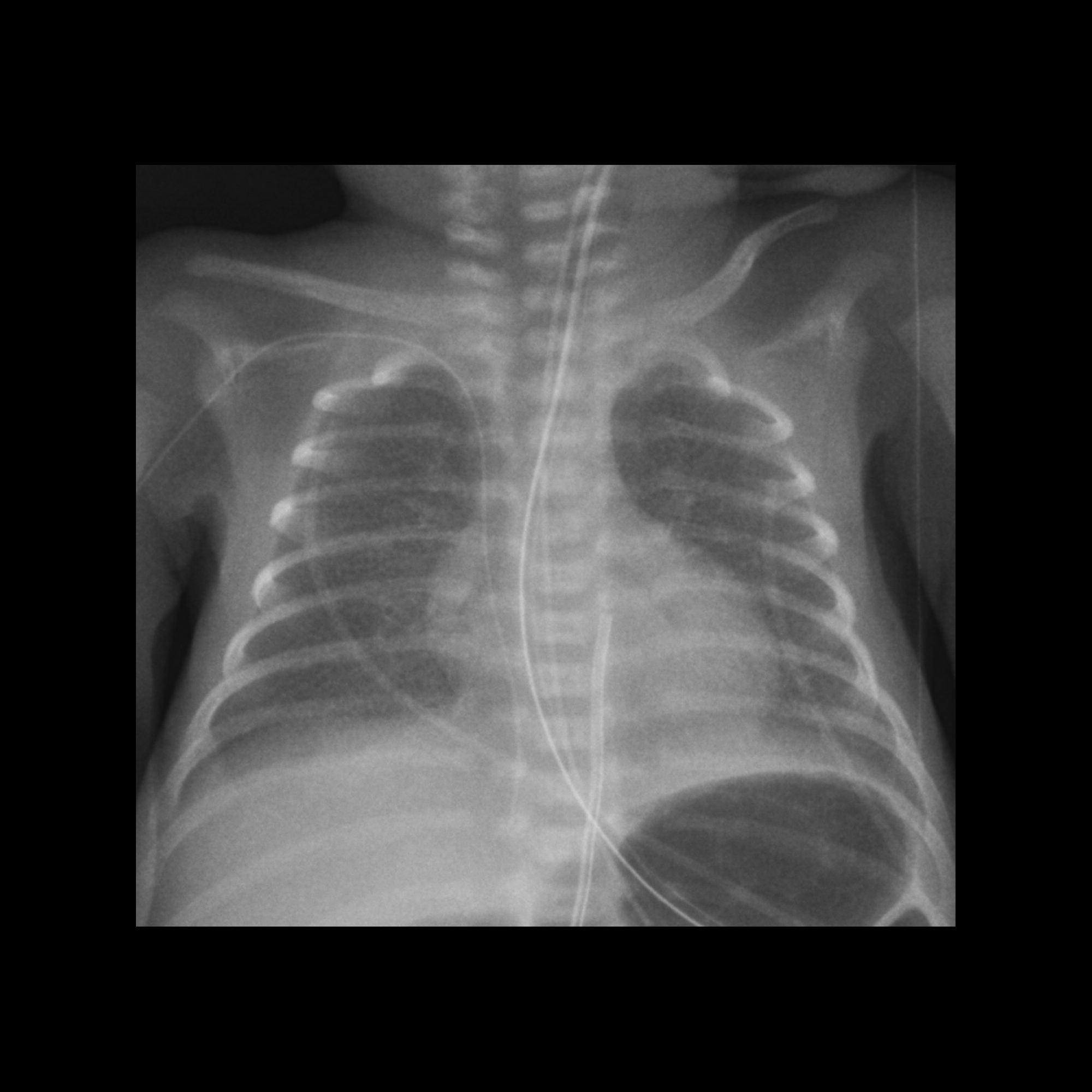 low malposition of the PICC | pacs