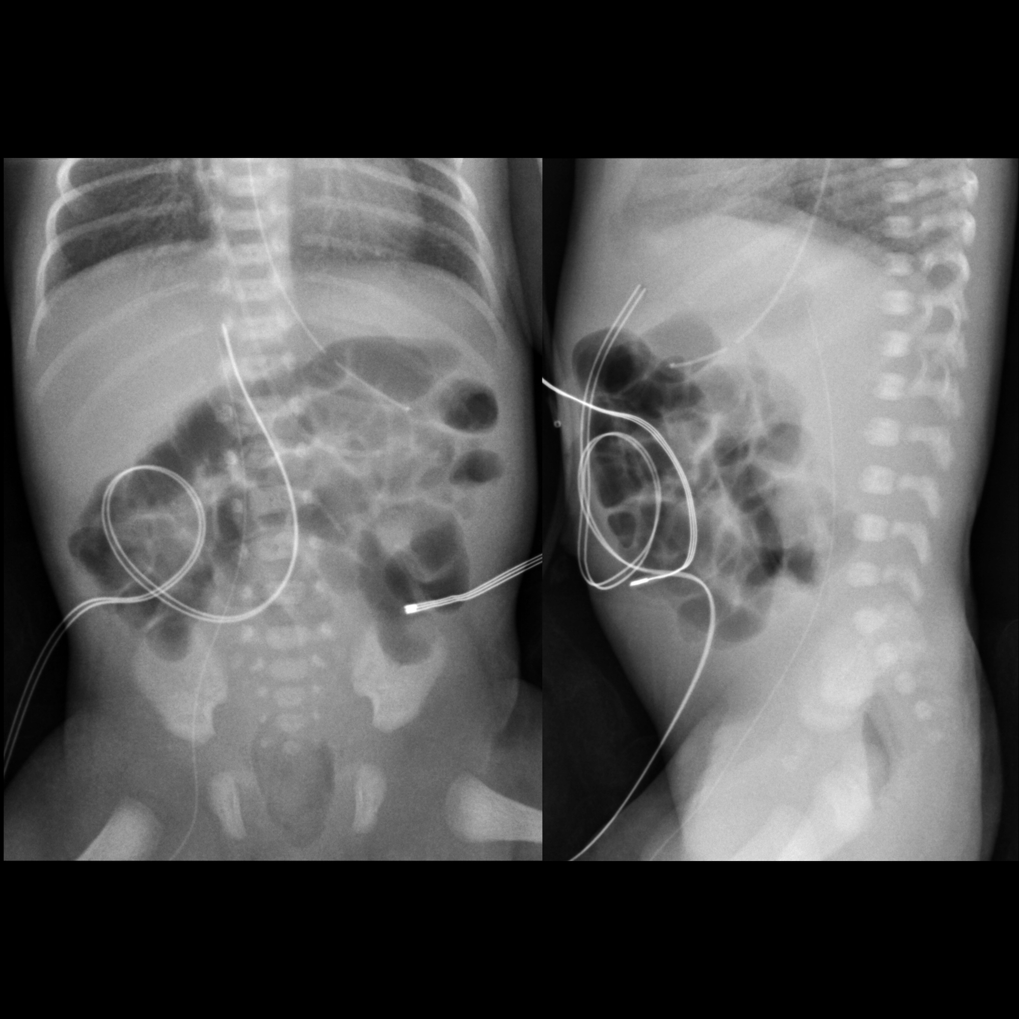 appropriate position of the PICC | pacs