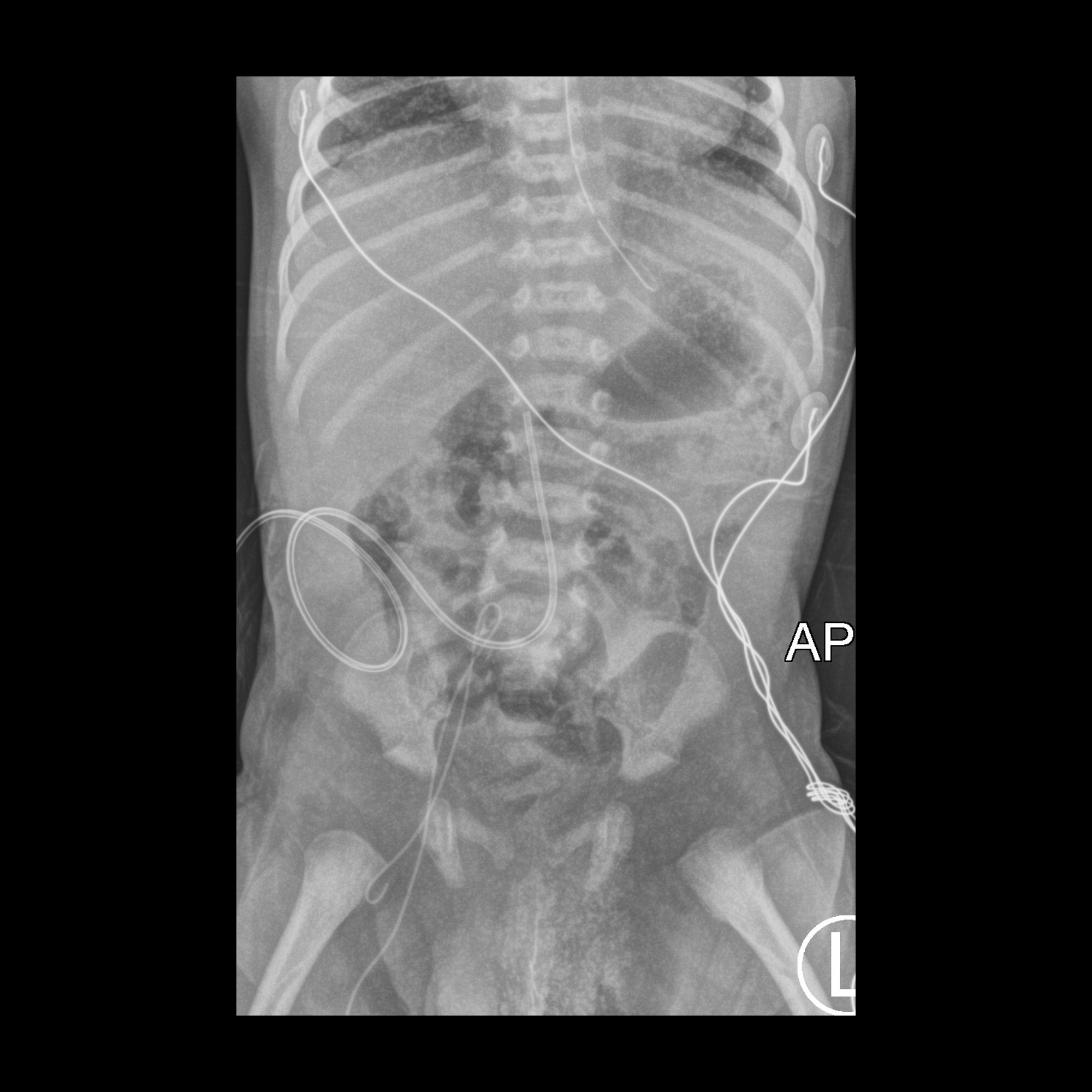 low malposition of the PICC | pacs