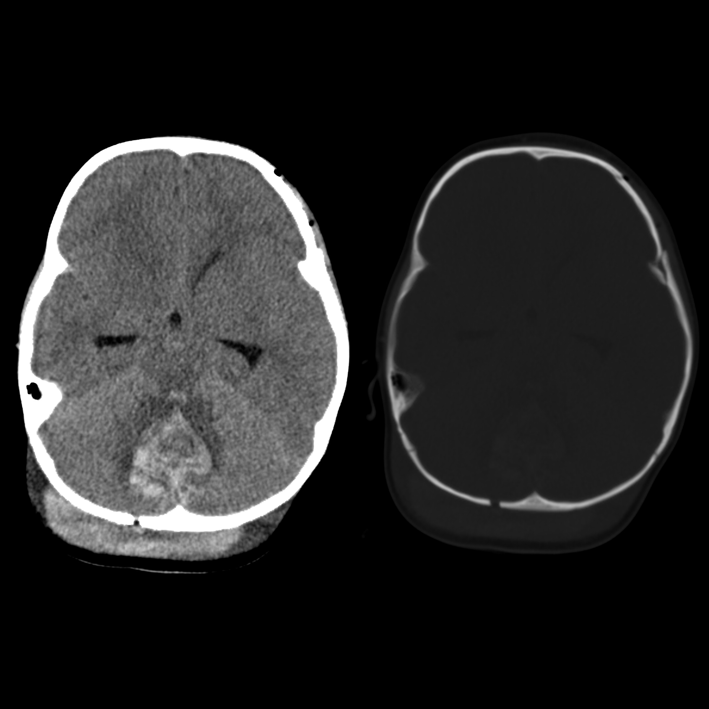 Depressed Skull Fracture Pacs