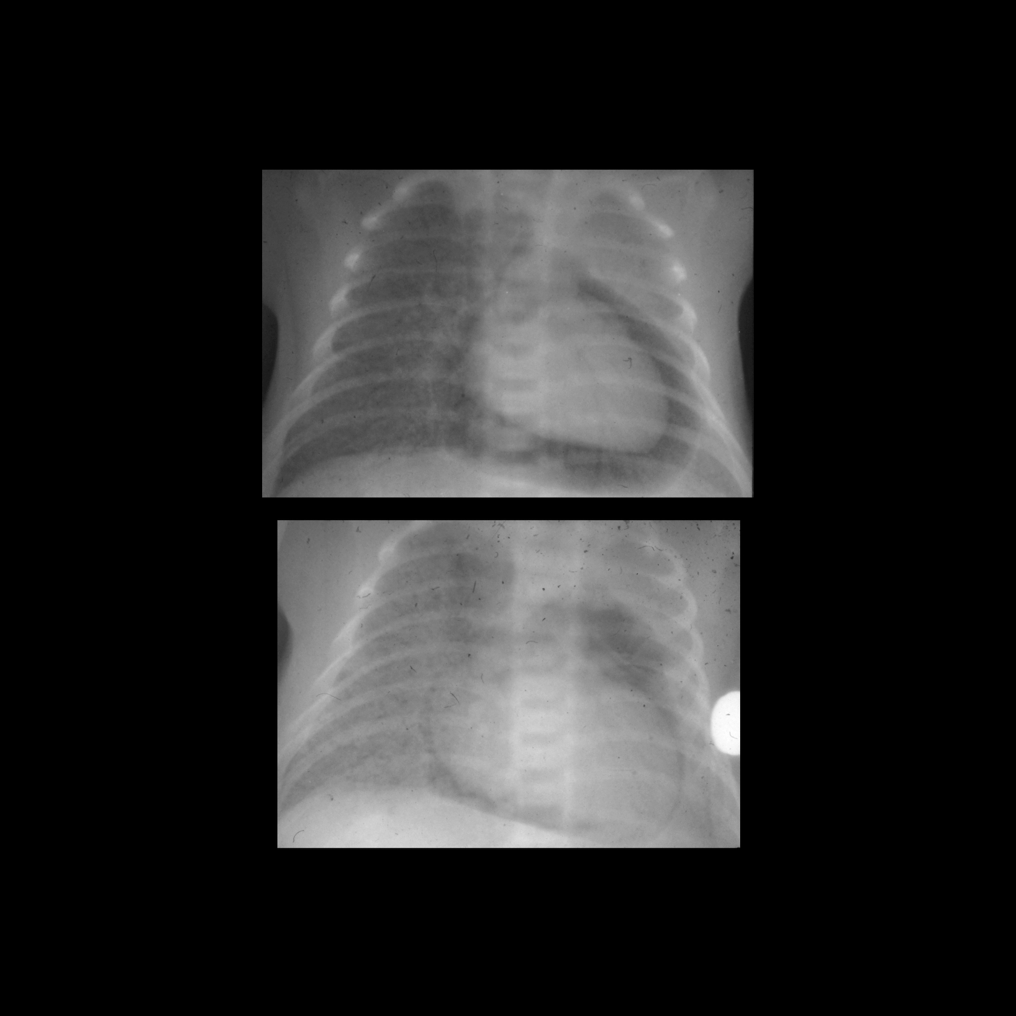 pneumopericardium-pacs