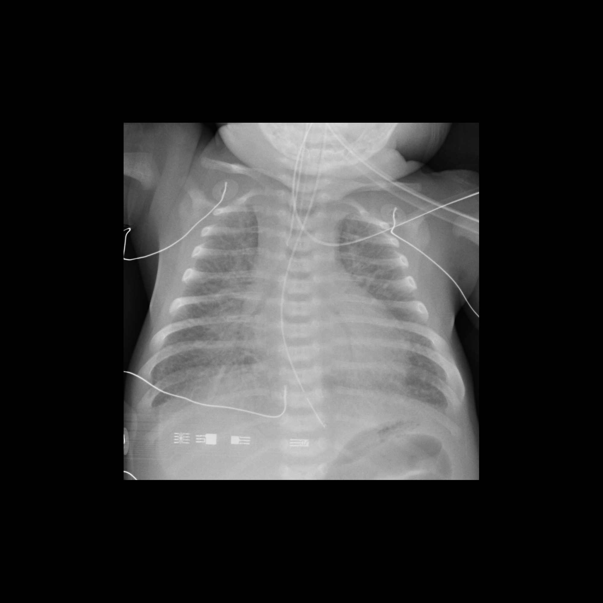 tachyarrythmia-cardiomyopathy-pacs