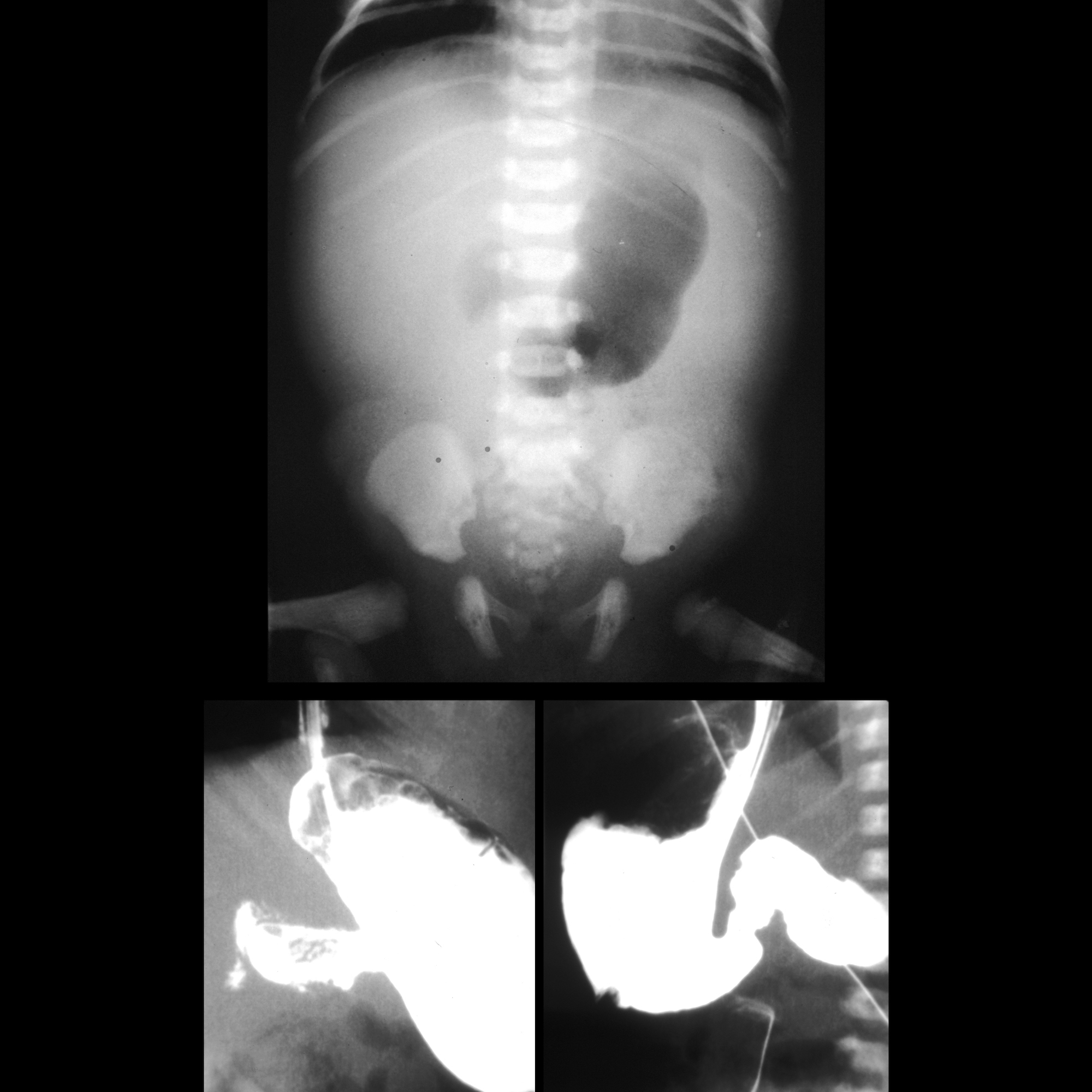 duodenal-web-pacs