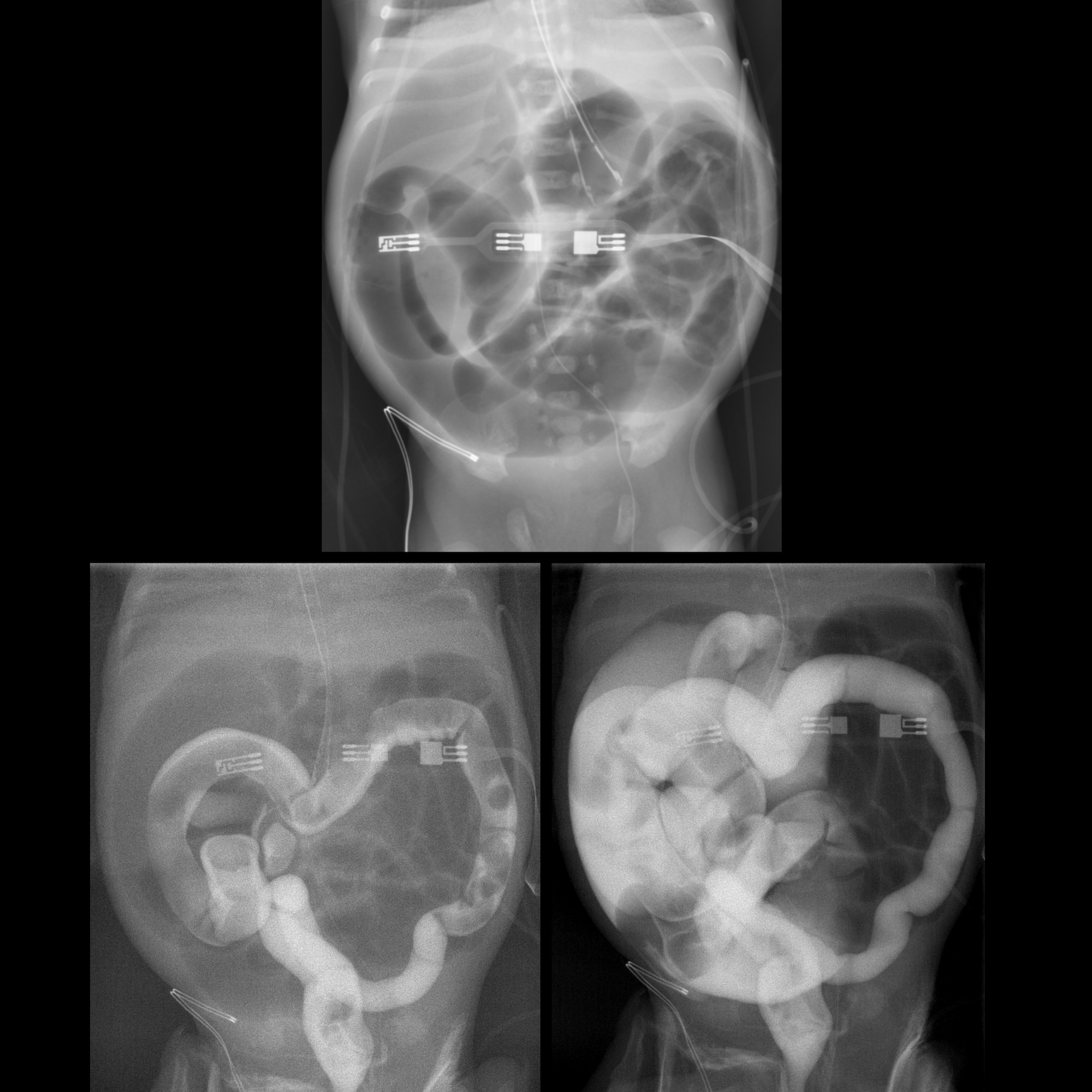 abdominal-distension-pacs