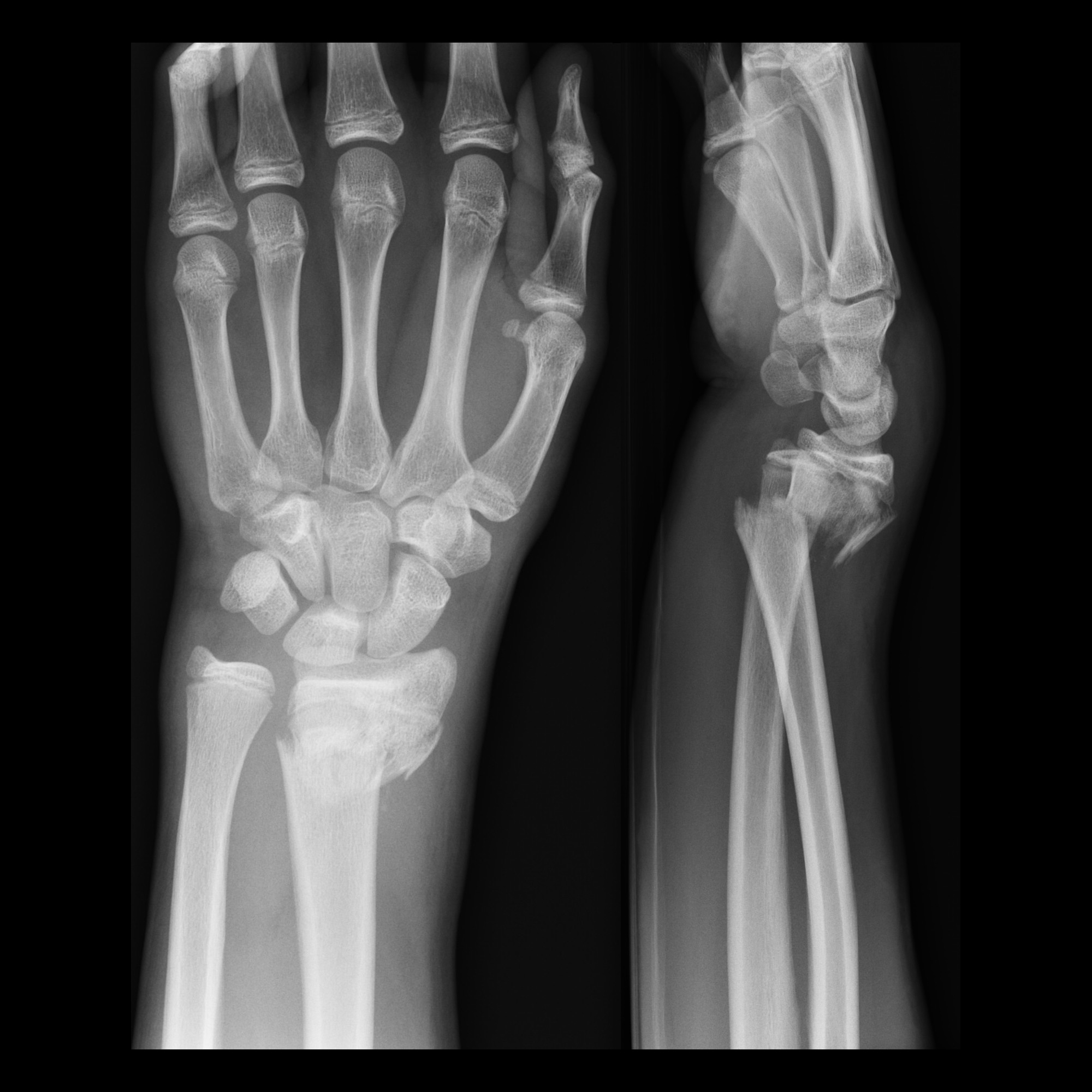 smith fracture