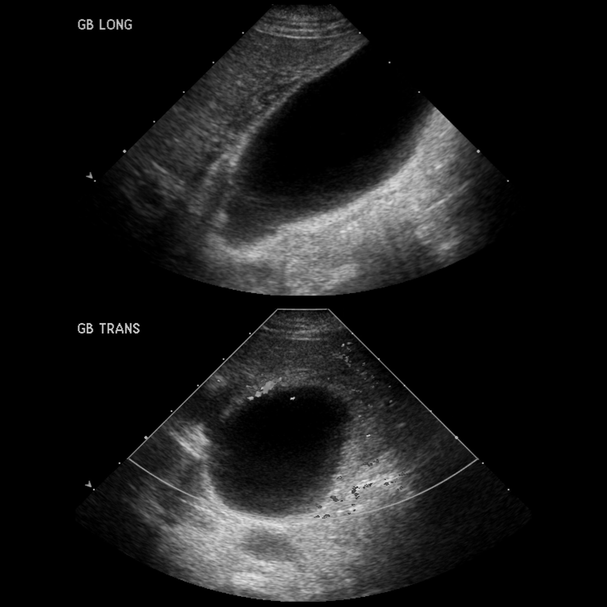 distension-of-the-gallbladder-pacs