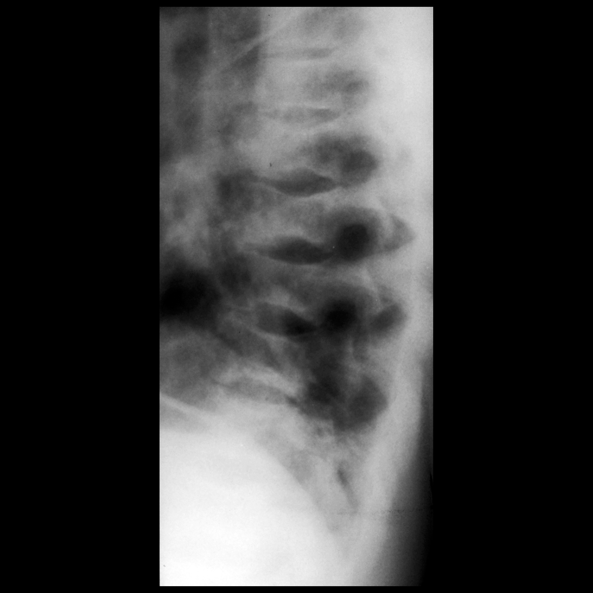 skeletal-manifestations-of-sickle-cell-disease-pacs