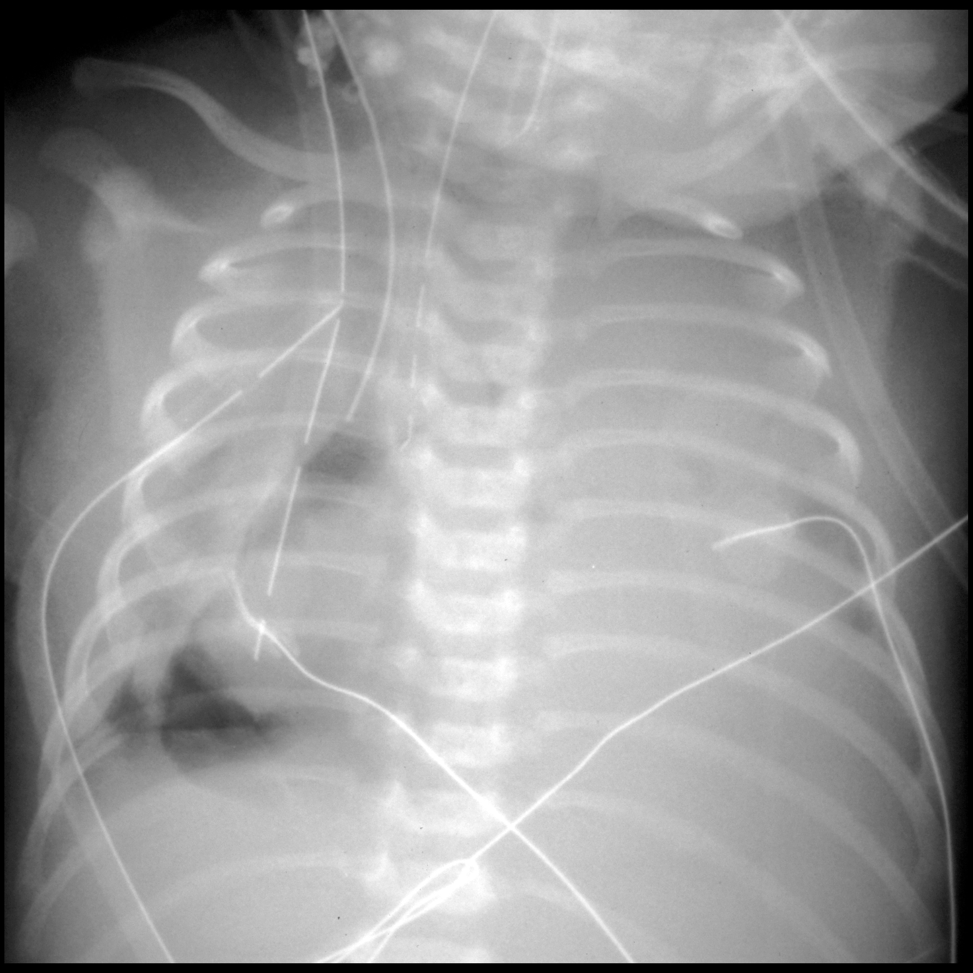 Extrakorporale Membranoxygenierung | pacs