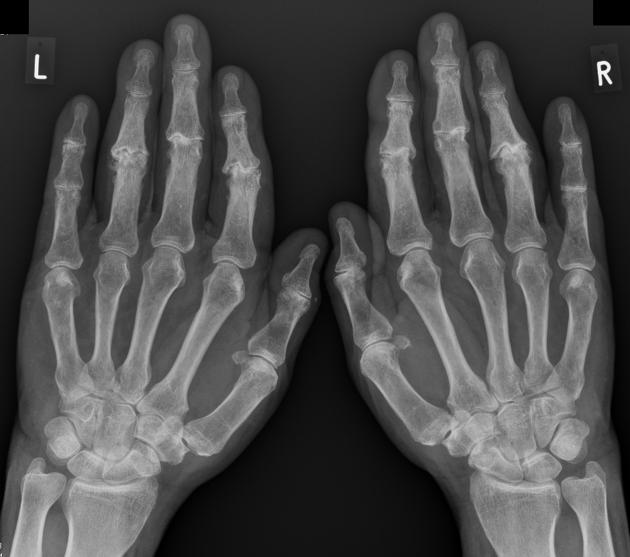 erosive osteoarthritis | pacs