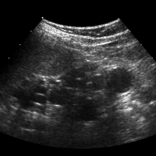 multicystic dysplastic kidney | pacs