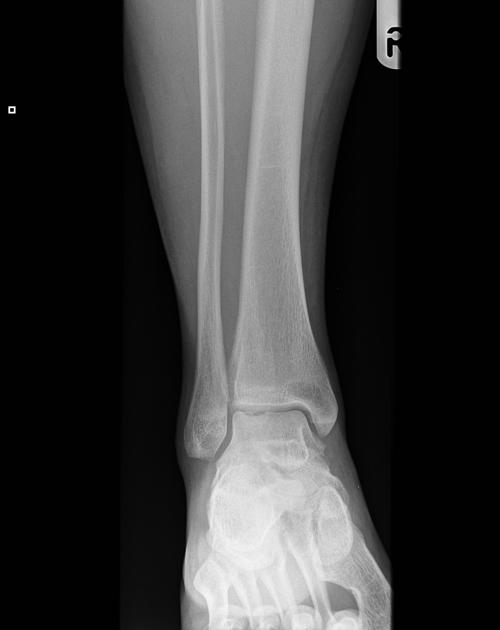 osteochondral defect | pacs