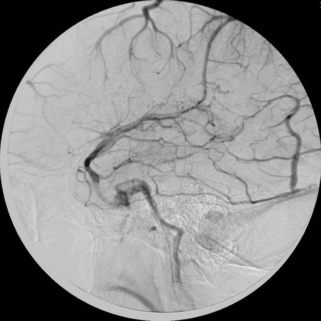 Superior cerebral veins - Wikipedia