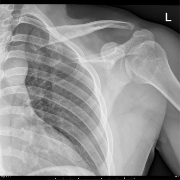 acromioclavicular joint dislocation x ray