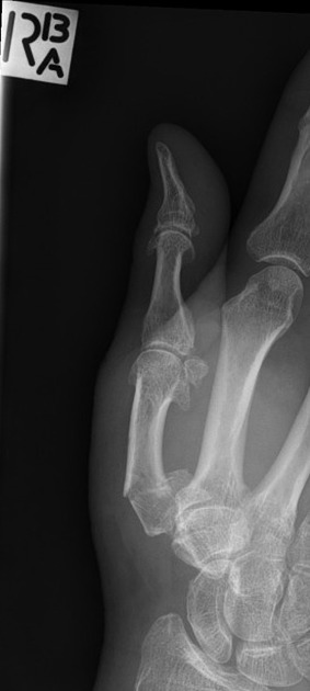 epibasal fracture of the thumb | pacs