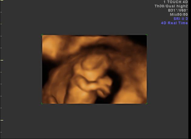 Exencephaly In Hindi