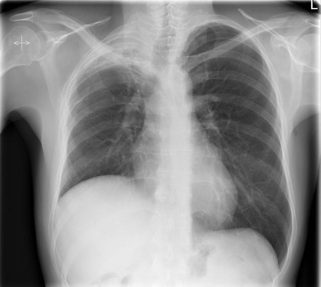 unilateral hypertranslucent hemithorax | pacs