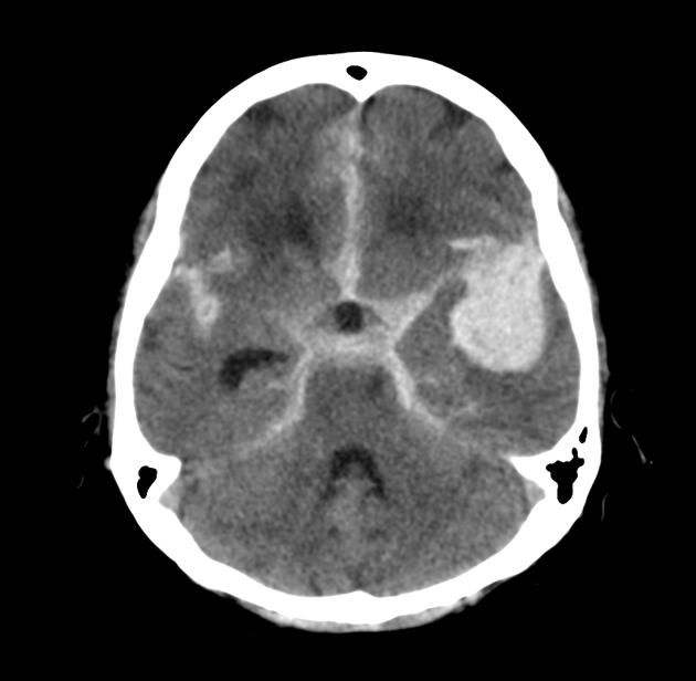 Subarachnoid hemorrhage - Wikipedia