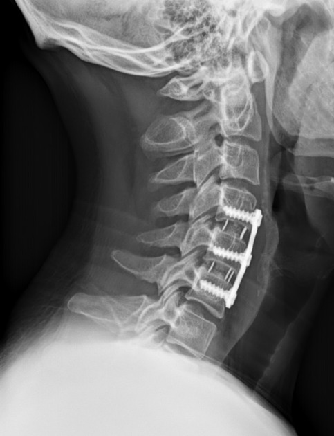 Anterior Cervical Discectomy And Fusion Acdf Pacs