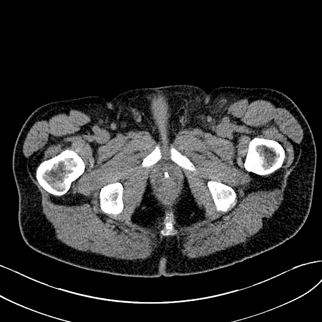 Definition Of Urethral Calculus