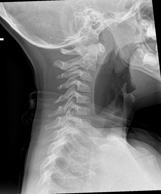 pseudosubluxation of the cervical spine | pacs