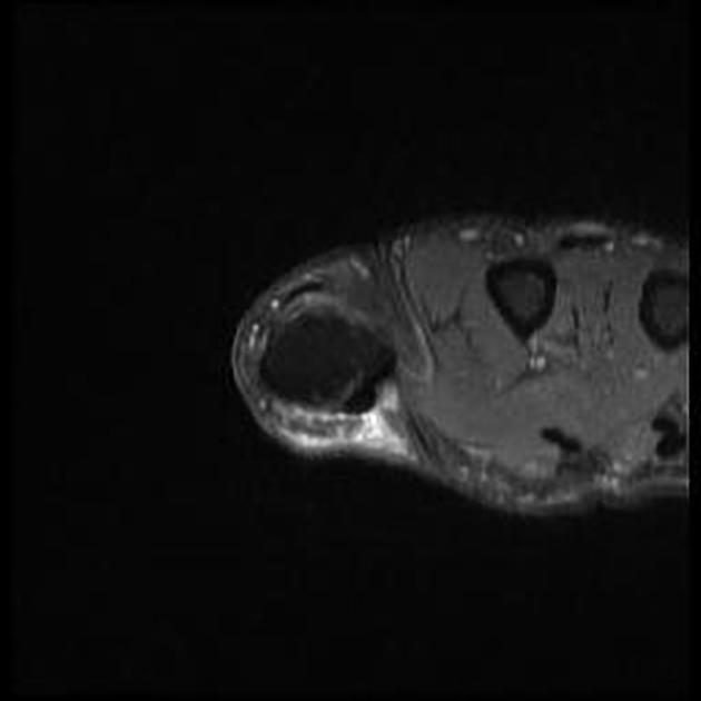 pulley lesion of the fingers pacs