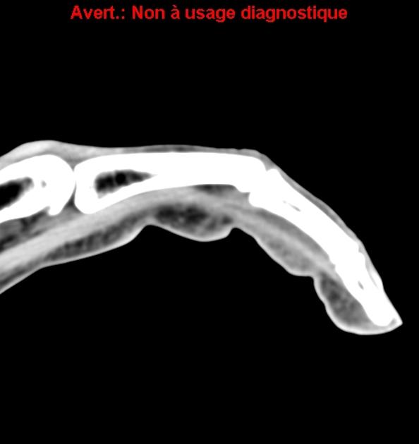 annular pulley lesions pacs