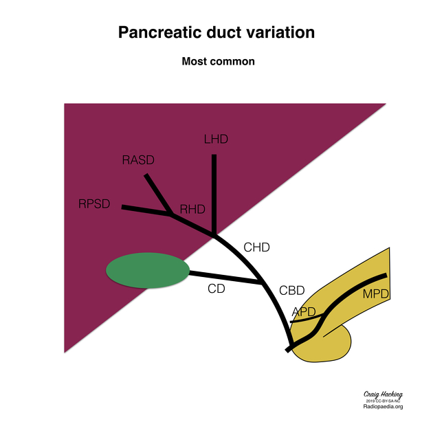 pancreas divisum mrcp