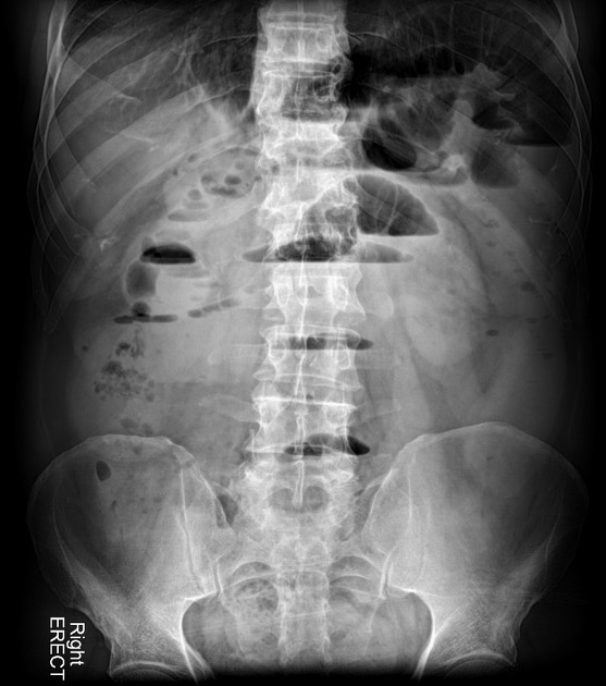 Small Bowel Obstruction Pacs