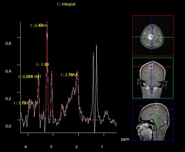 MR Spectroscopy Pacs