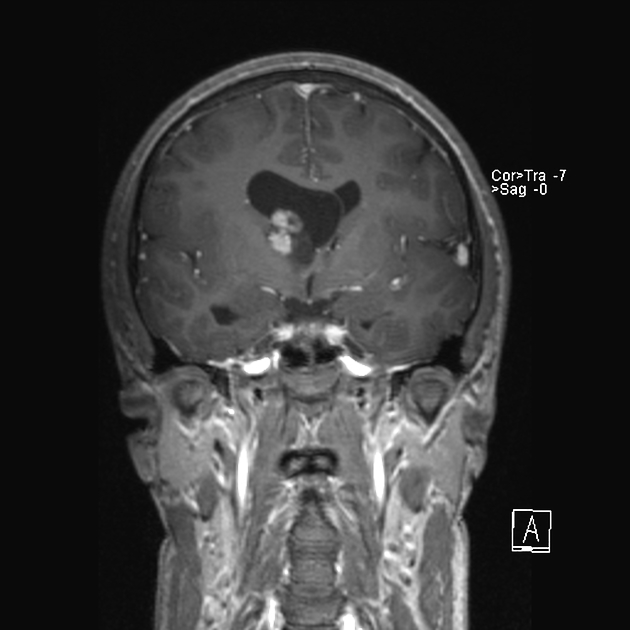 Subependymal Giant Cell Astrocytoma Pacs