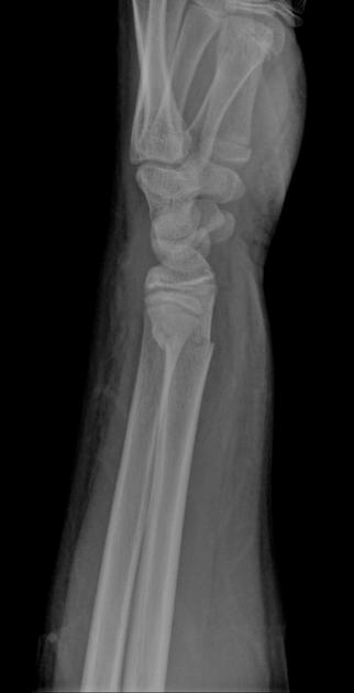 Colles' fracture - Wikipedia
