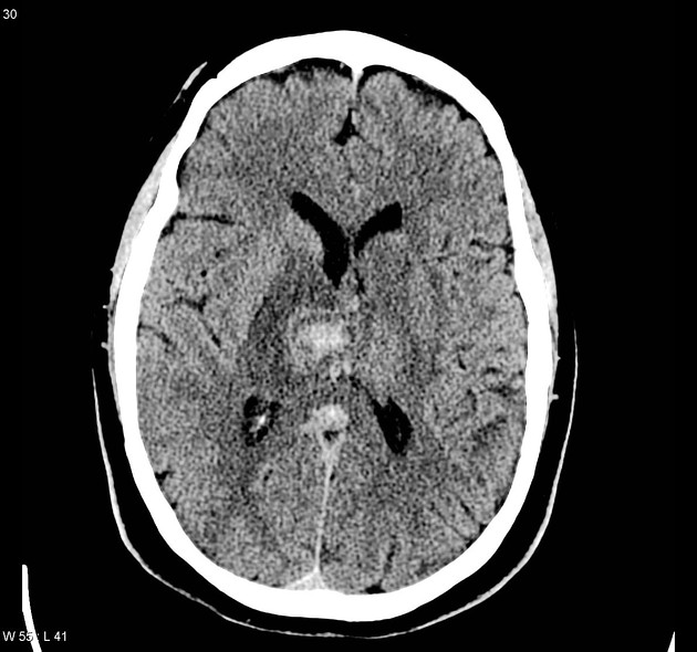 Venous vascular territories of the lateral cerebral cortex (illustration), Radiology Case