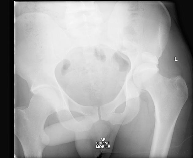 Posterior Hip Dislocation Pacs